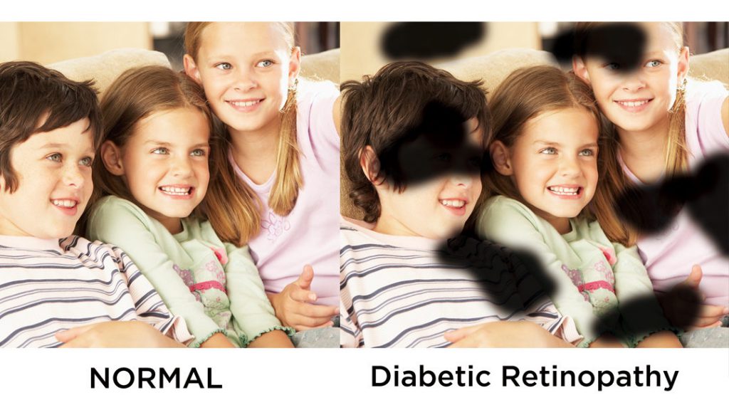 retinopatia cukrzycowa jak widzi