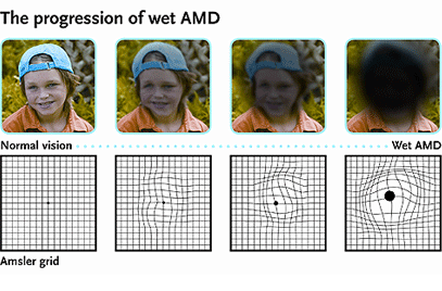 amd zwyrodnienie plamki jak widzi