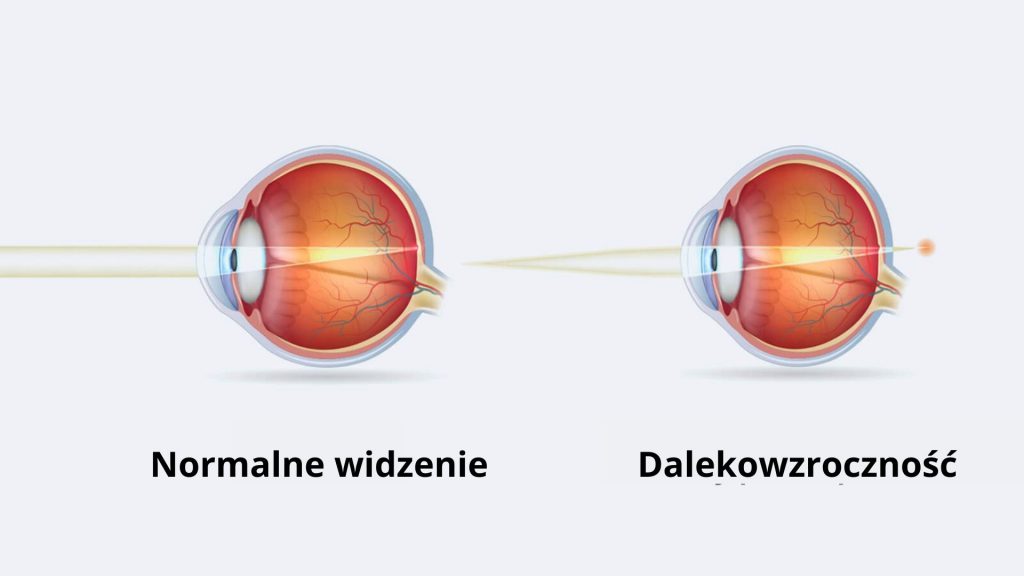 dalekowzroczność przyczyny