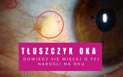 Tłuszczyk Oka – Narośl Na Oku (Co To Takiego?)