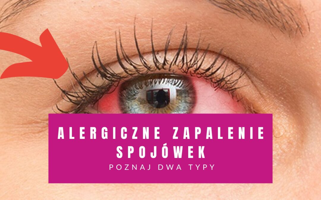 Alergiczne Zapalenie Spojówek – Poznaj Jego DWA Typy