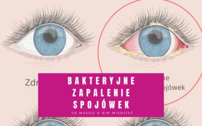 Bakteryjne Zapalenie Spojówek – Co Musisz Wiedzieć