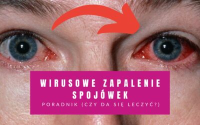 Wirusowe Zapalenie Spojówek – Poradnik (Czy Da Się Leczyć?)