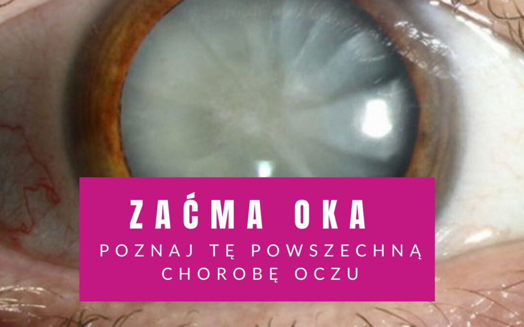 Zaćma – Co To? Poznaj Tę Powszechną Chorobę Oczu