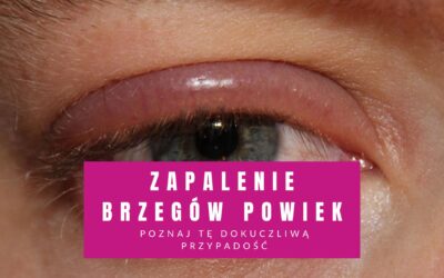 Zapalenie Brzegów Powiek – Poznaj Tę Dokuczliwą Przypadłość