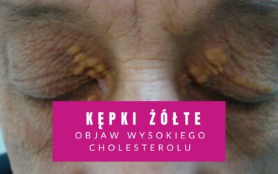Kępki Żółte – Jasny Objaw Wysokiego Cholesterolu