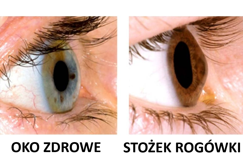stożek rogówki