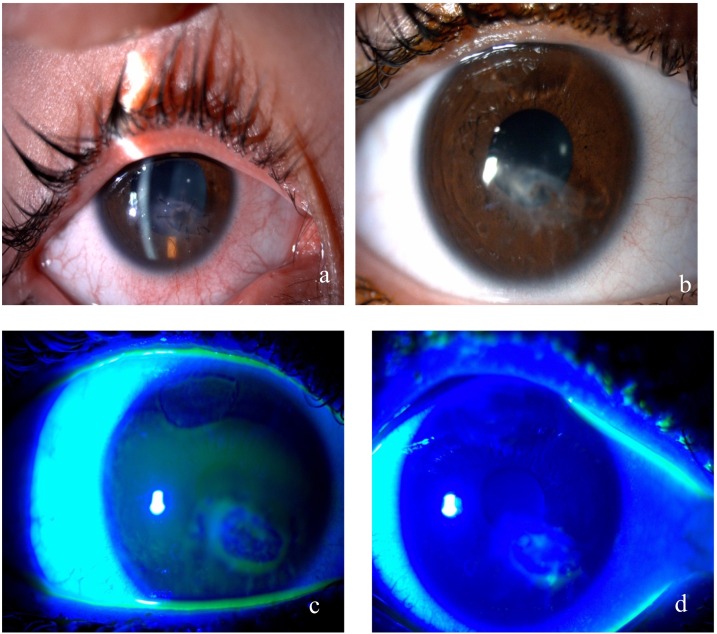 perforacja rogówki oka
